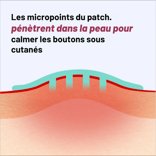 PATCHS Micropoints